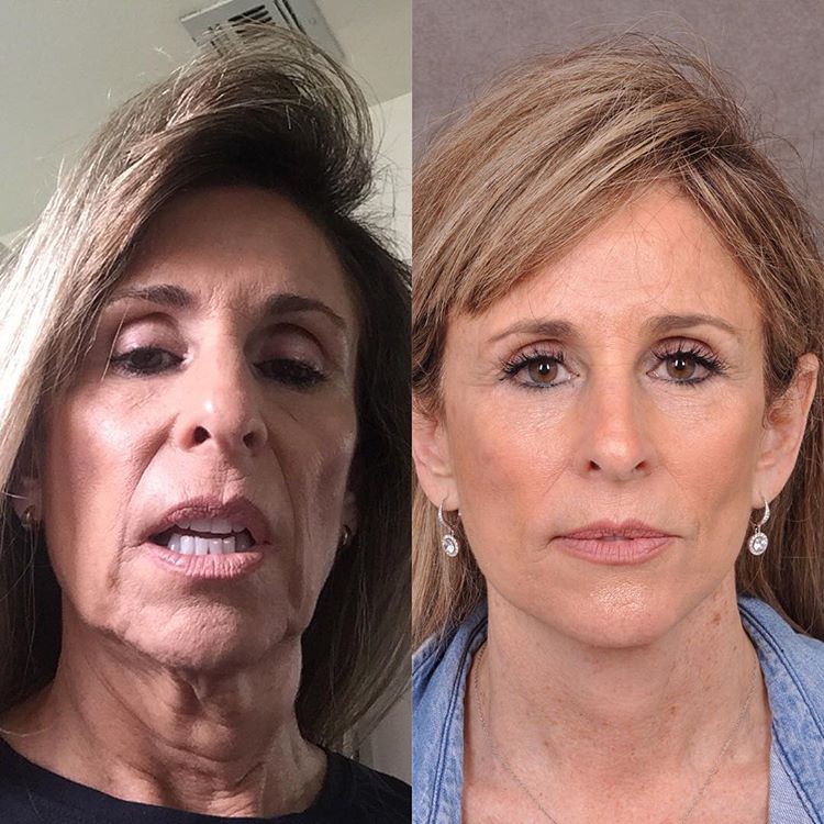 Женщины 55+ до и после пластики лица Auralyft - носогубки и шея