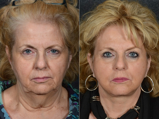 Женщины 55+ до и после пластики лица Auralyft - лишний вес