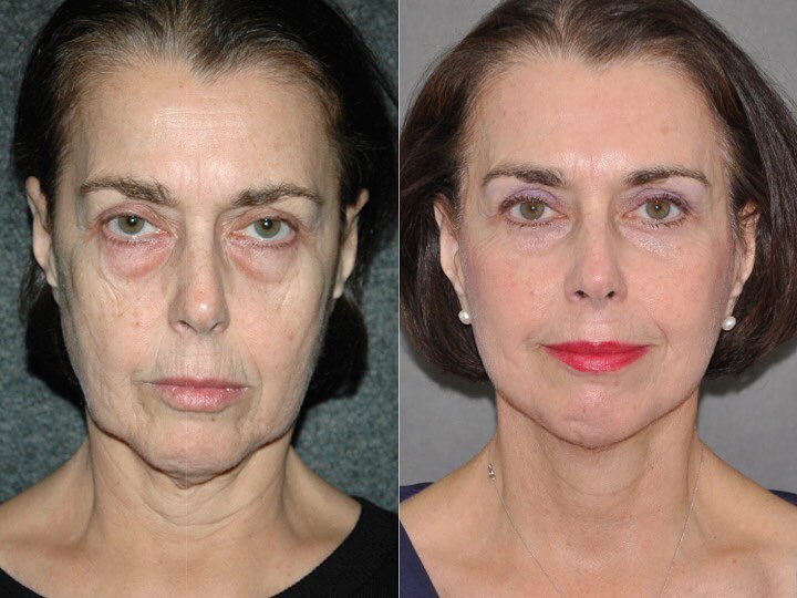 Женщины 55+ до и после пластики лица Auralyft - мешки и морщины