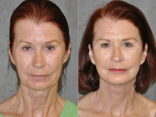 Женщины 55+ до и после пластики лица Auralyft - шея