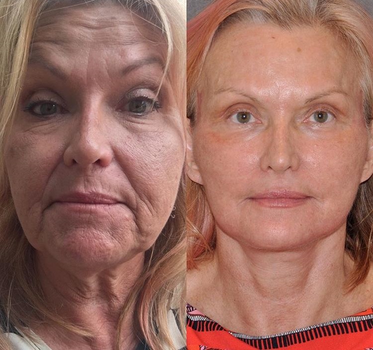 Женщины 55+ до и после пластики лица Auralyft - одутловатьсть