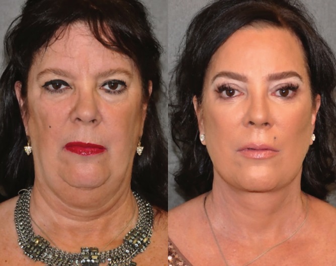Женщины 55+ до и после пластики лица Auralyft - Карен Хоутон