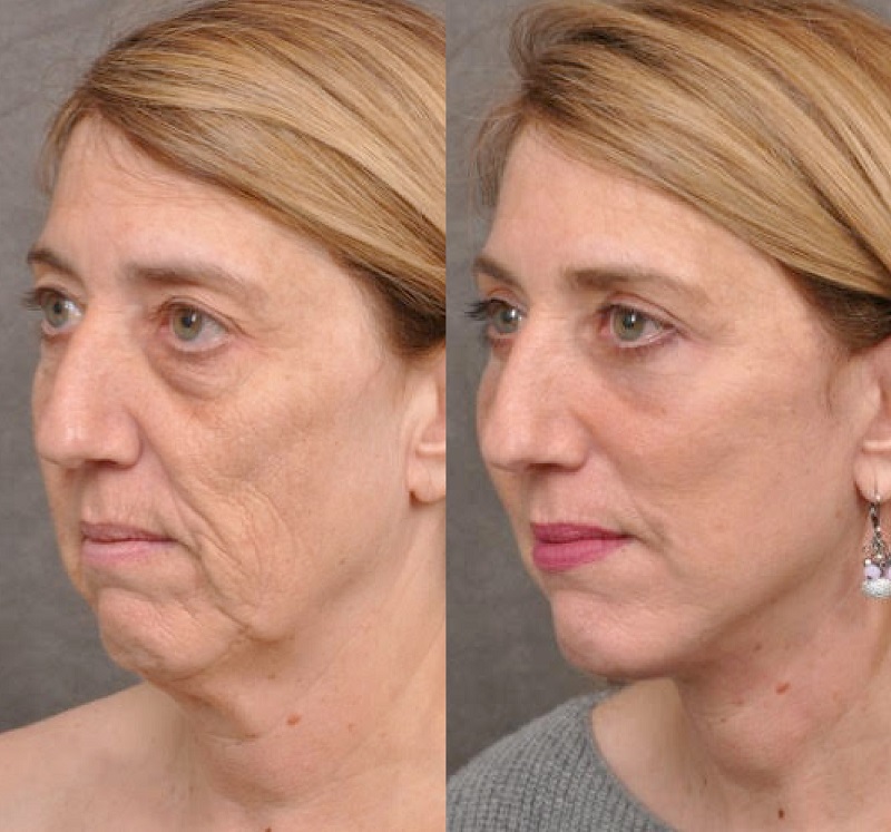 Женщины 55+ до и после пластики лица Auralyft - шея и брыли